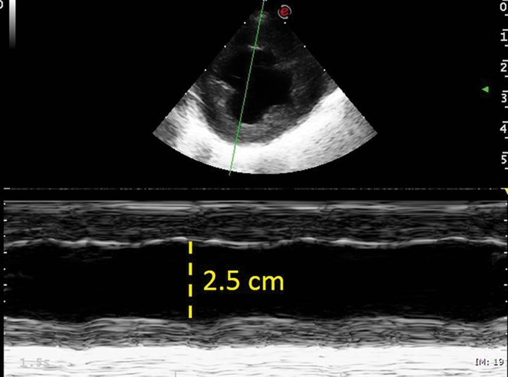 Mechanical ventilation to treat severe congestive heart failure