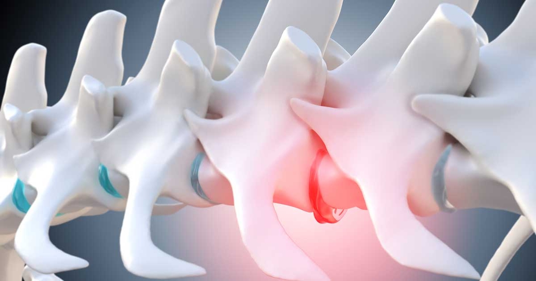 Nursing patients with intervertebral disc disease
