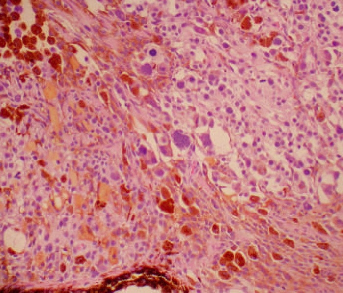 FELINE DIFFUSE IRIDAL MELANOMA