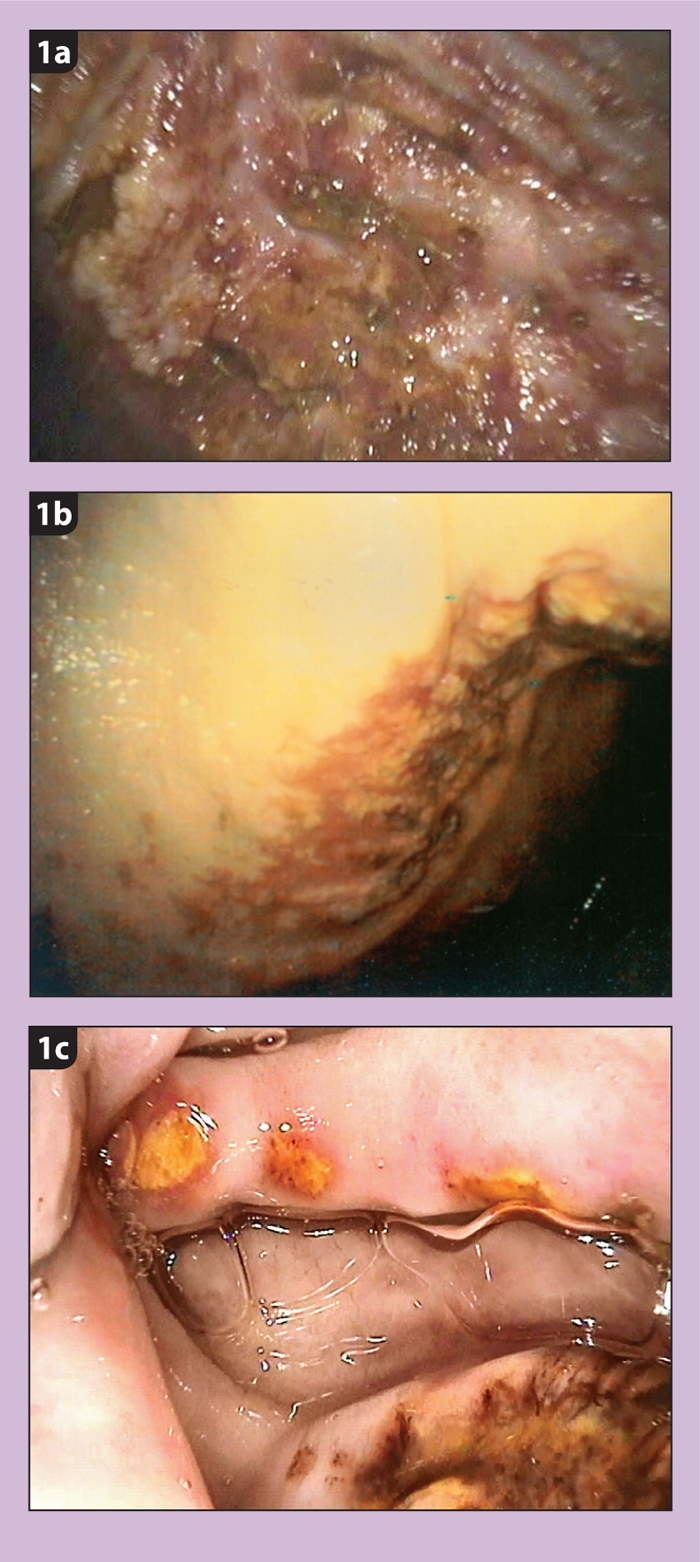 Treating equine gastric ulcers