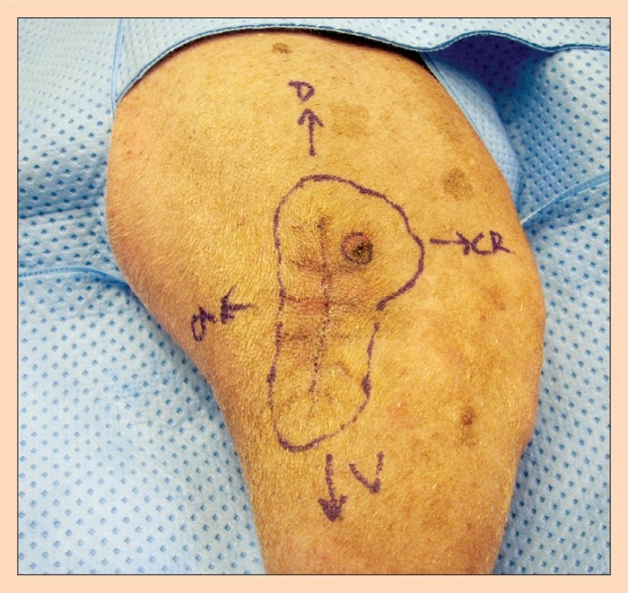 Cutaneous mast cell tumours in canines – part two: treatment