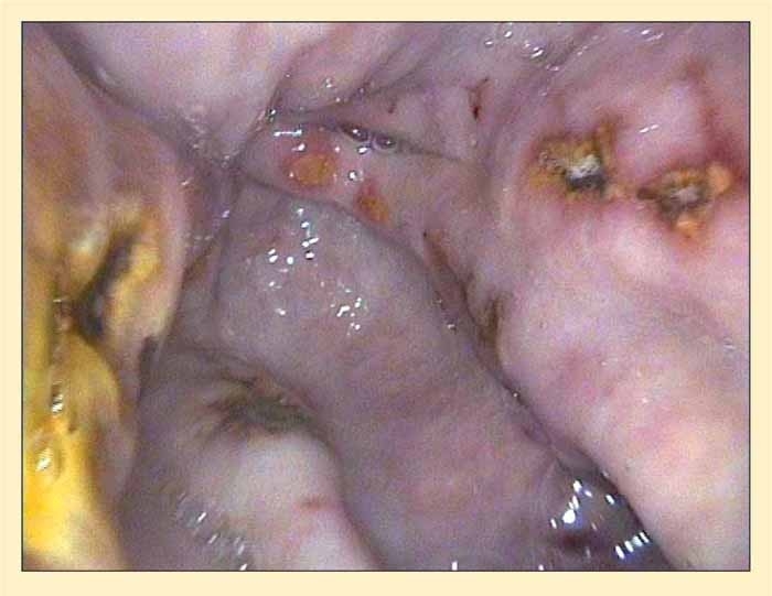 Thirty years of gastric ulceration: what’s known and still to learn?