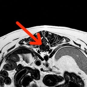 Thoracolumbar intervertebral disc disease in a shih-tzu