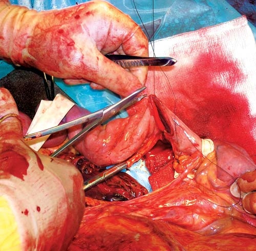 Avoiding pitfalls in small intestinal anastomosis
