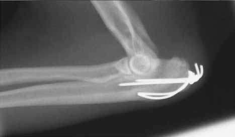 Physeal fractures in immature cats and dogs: part 1 – forelimbs