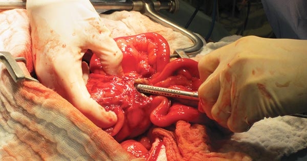 Treatment of septic peritonitis