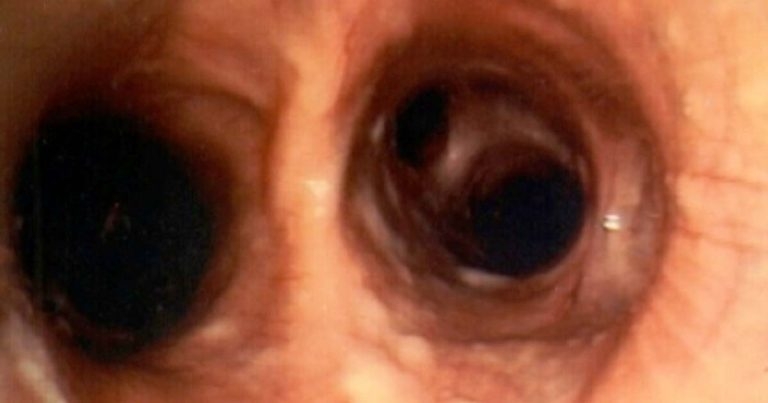 Infectious respiratory disease in young horses