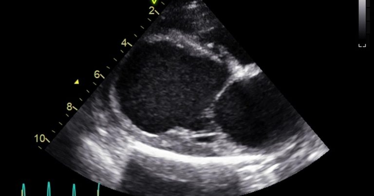 Dilated cardiomyopathy in dogs: causes and treatment