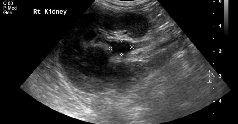 Pyelonephritis in a dog