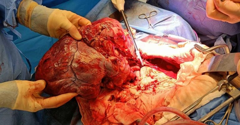 Vets remove massive malignant mass