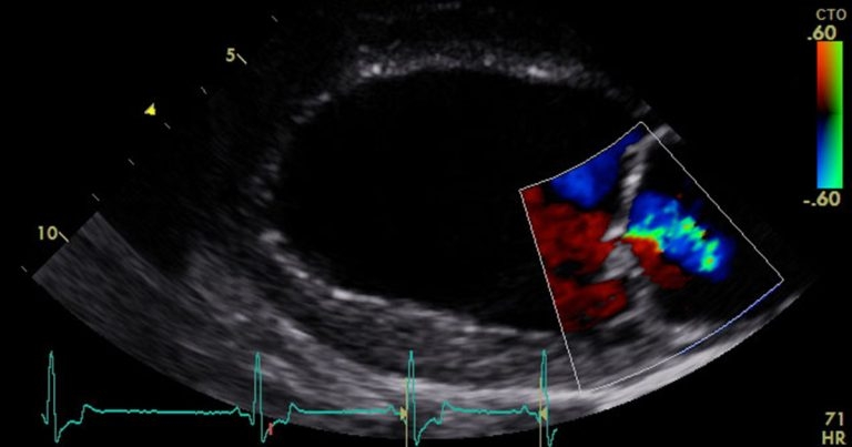 Chronic left-sided congestive heart failure: causes and care