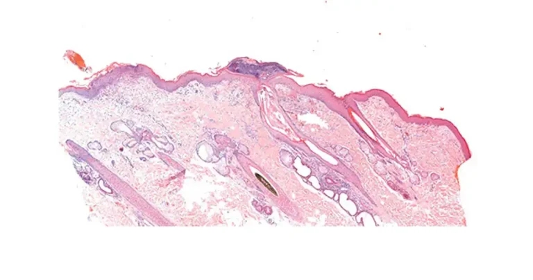 Canine pyoderma: a common dermatological challenge