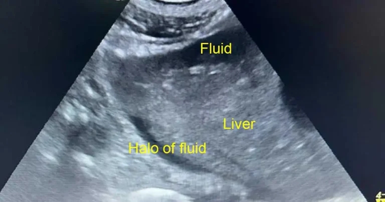 A practical approach to diagnosis and treatment of haemoabdomen