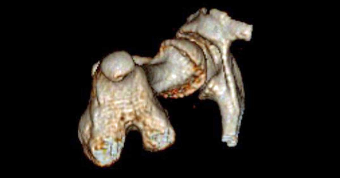 Distal femoral osteotomy for treatment of femoral retroversion