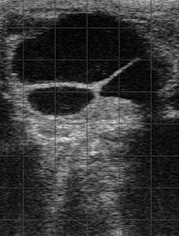Ovarian cysts in dairy cattle