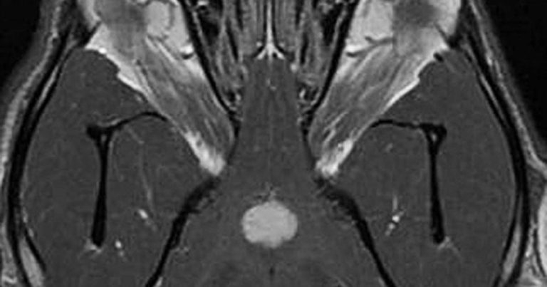 Neurological pituitary tumour manifestations
