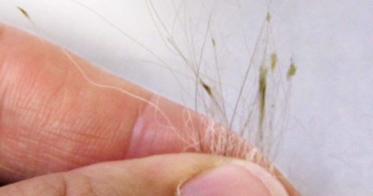 Sebaceous adenitis management