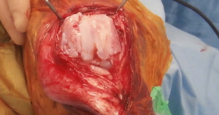 Approaches to treating OA