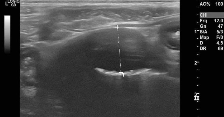 Investigating second degree AVB in German short-haired pointer