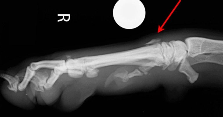 A Pancarpal arthrodesis Labrador retriever case