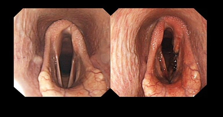 Update on recurrent laryngeal neuropathy research in horses