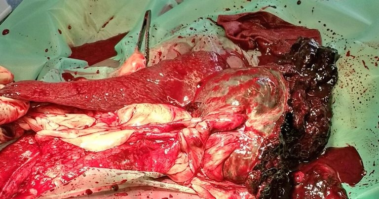 Splenic rupture: a critical care plan of action