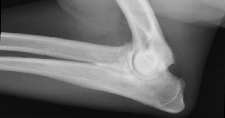 Overview of osteoarthritis