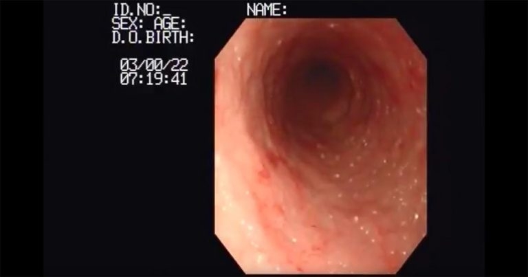 Inflammatory bowel disease – diagnosis and treatment