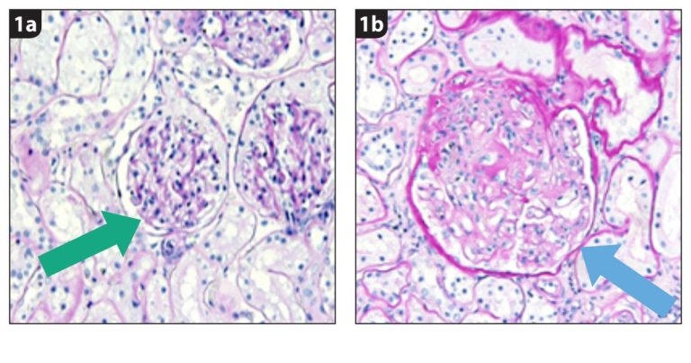 Combined management of feline hypertension, CKD and proteinuria