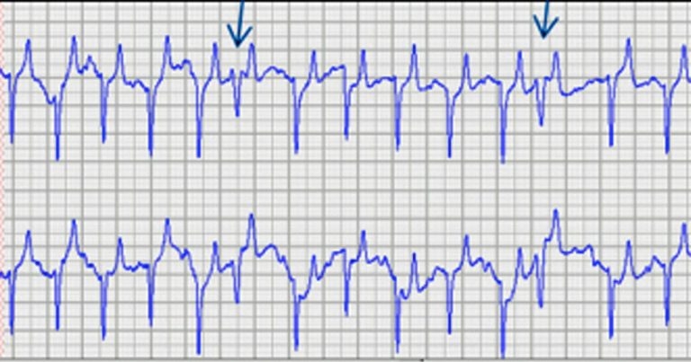 Equine cardiac dysrhythmia