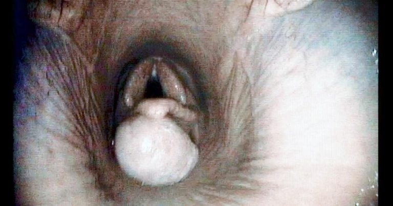 Equine subepiglottic cysts