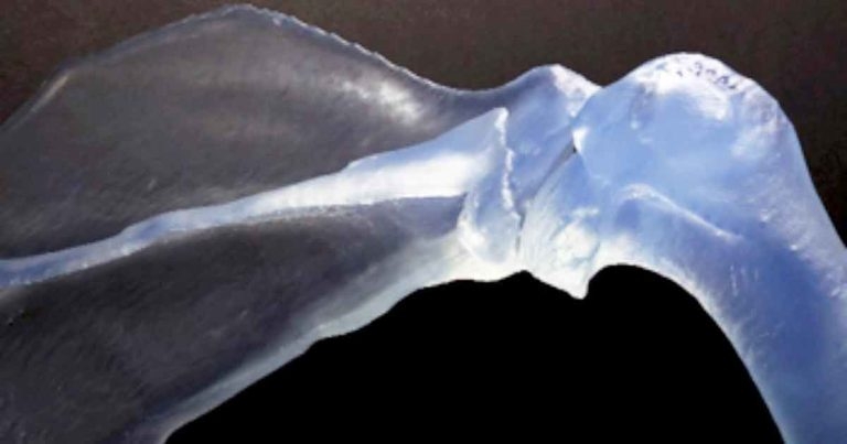 Applying use of 3D printing for appendicular surgery