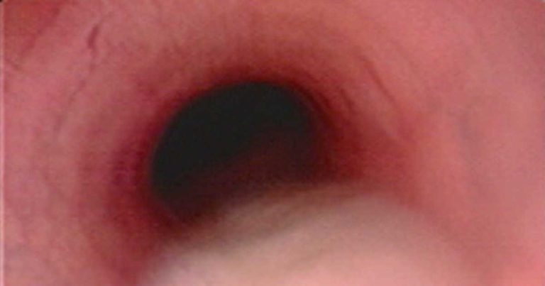 Coughing in adult horses