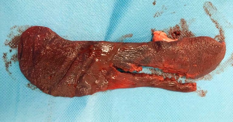 Autologous blood transfusion – what, when and how to do it