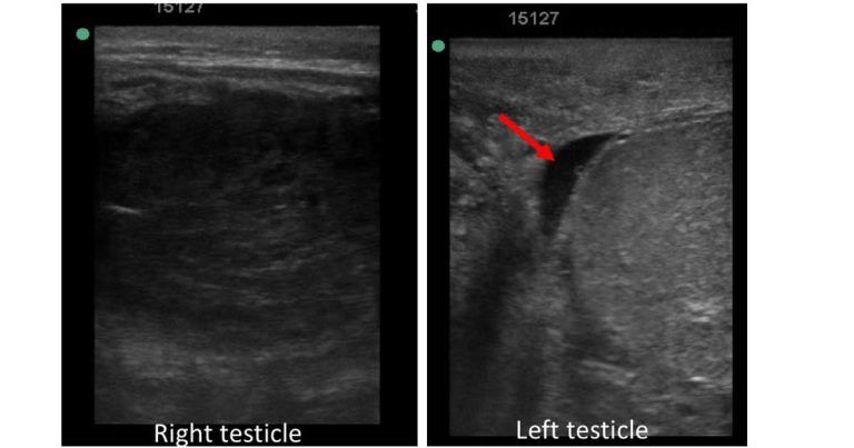 A colt with scrotal swelling