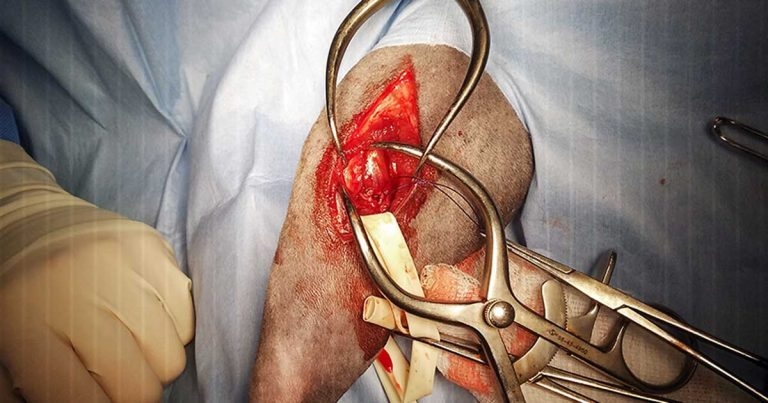 Avulsion of the lateral head of the gastrocnemius muscle in a cat