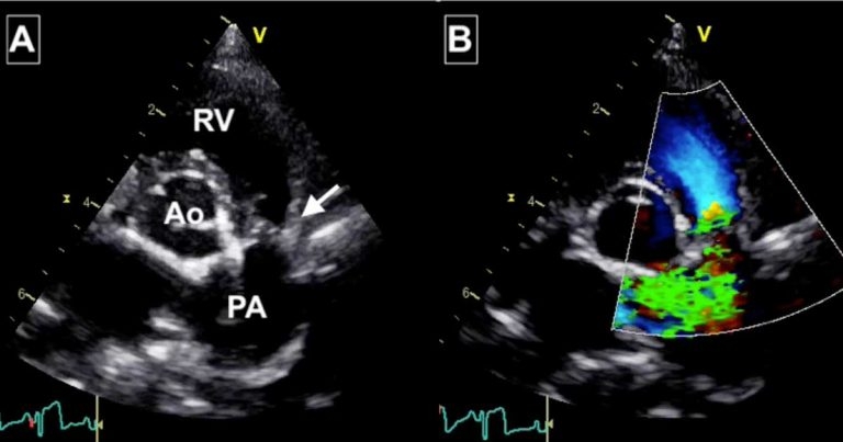 Canine congenital heart disease