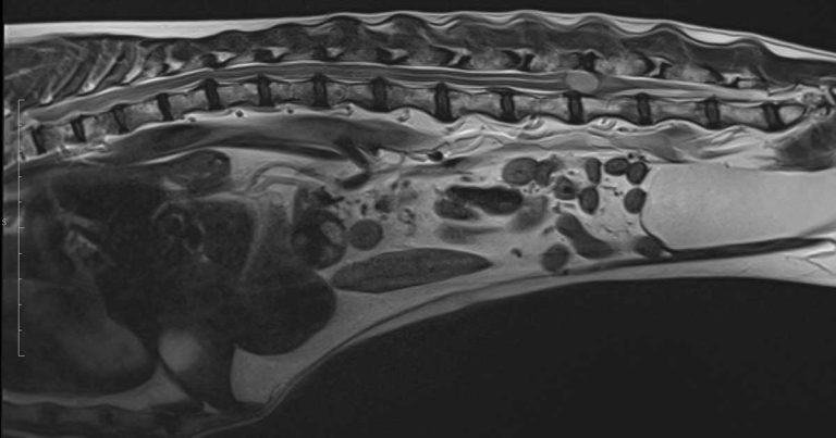 A case of canine atypical spinal choroid meningioma