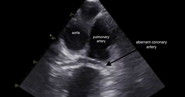 Heart disease in dogs