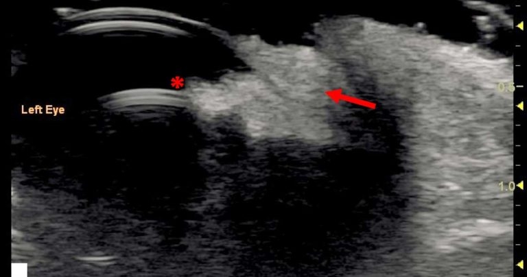 Ocular ultrasonography – part 2