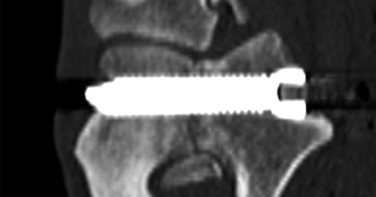 Treatment of a condyle fissure and medial coronoid fragment