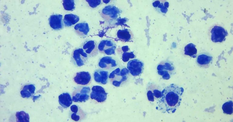 Erosive polyarthritis – diagnosis and treatment on a budget