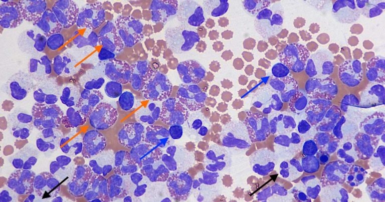 Cytology findings from an abdominal effusion in a dog