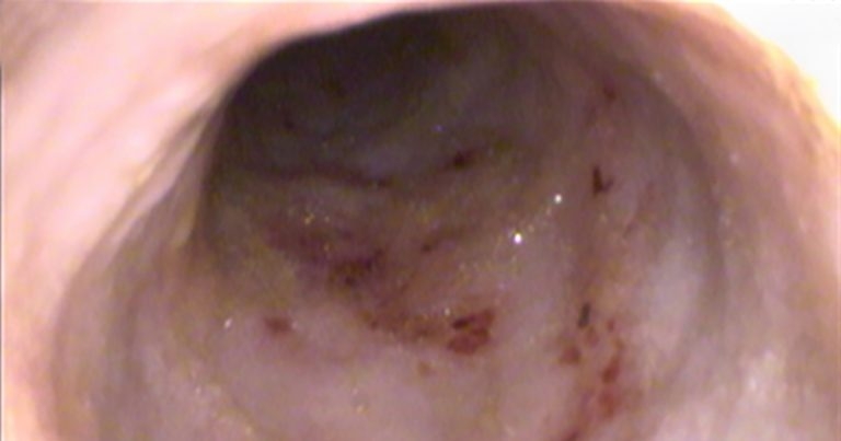 Gastrointestinal disease – deciding whether to scope