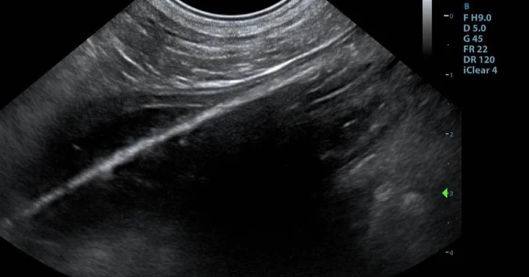 Case of a foreign body in a dog discovered by ultrasonography