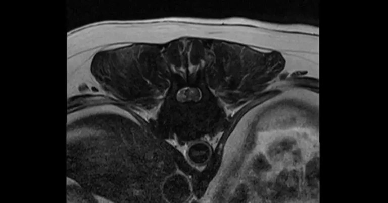 Intensive, varied and rewarding: guide to nursing spinal patients