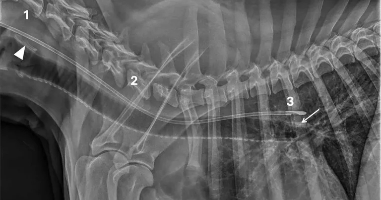 New radiographic guidelines to determine feeding tube placement